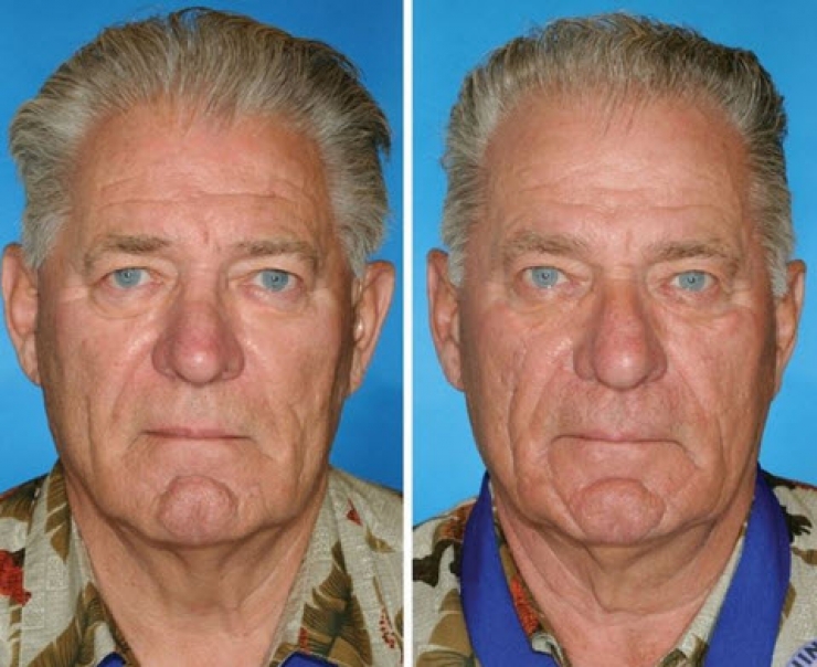 Fumeurs Vs Non Fumeurs Ces 8 Photos De Jumeaux Nous Montrent Que La poumons-du-fumeur-vs-poumons-sains-normaux
