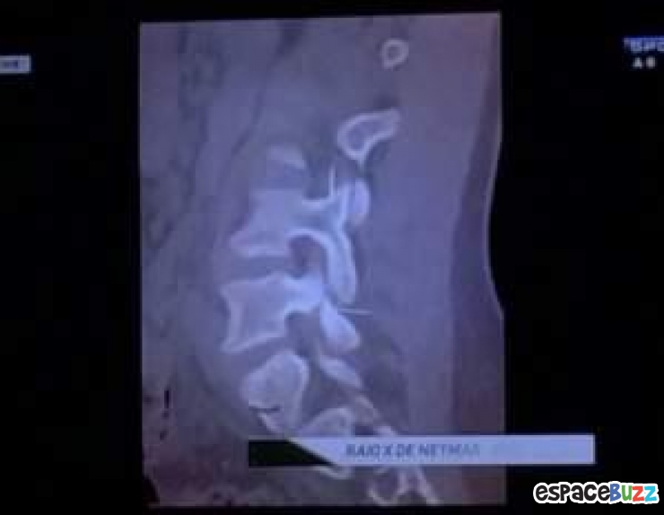 Illustration de l'article : Neymar passe &agrave; 2cm de la paralysie! Observez sa radio!