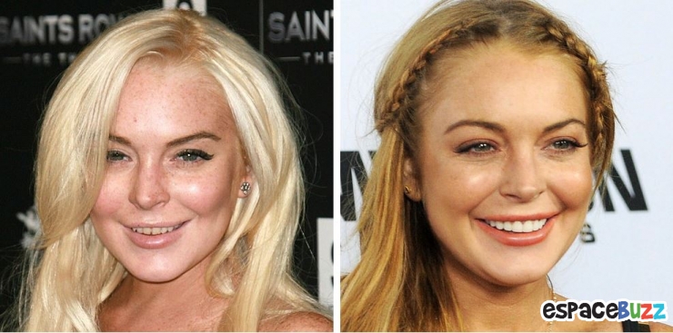 Illustration de l'article : 15 photos de c&eacute;l&eacute;brit&eacute;s avant et apr&egrave;s un bon rabibochage des dents