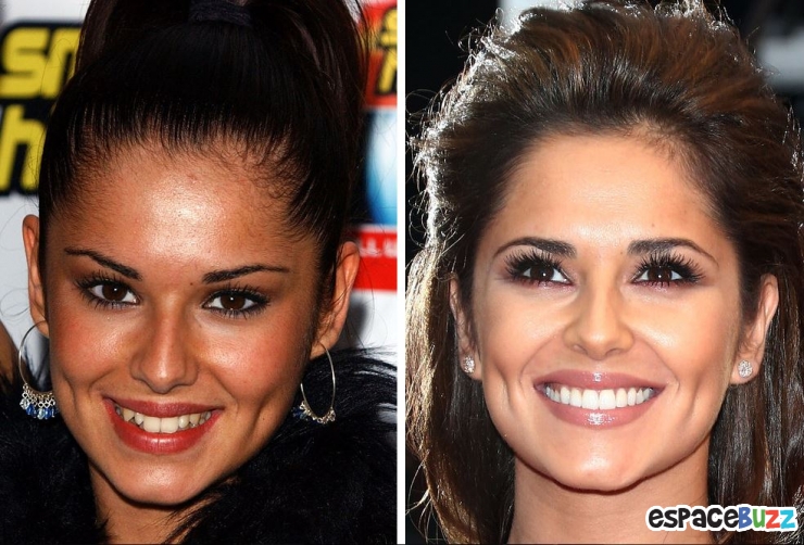 Illustration de l'article : 15 photos de c&eacute;l&eacute;brit&eacute;s avant et apr&egrave;s un bon rabibochage des dents