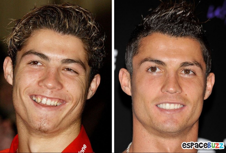 Illustration de l'article : 15 photos de c&eacute;l&eacute;brit&eacute;s avant et apr&egrave;s un bon rabibochage des dents