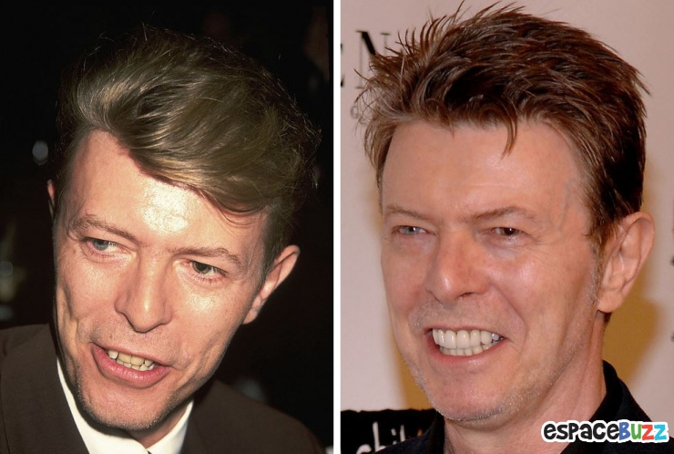 Illustration de l'article : 15 photos de c&eacute;l&eacute;brit&eacute;s avant et apr&egrave;s un bon rabibochage des dents