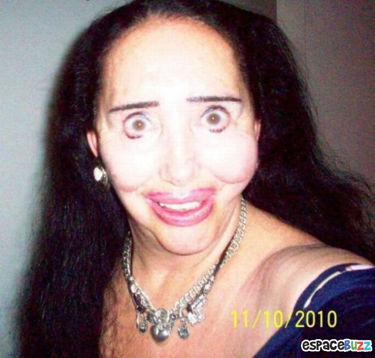 Illustration de l'article : Top 12 des chirurgies esthétiques les plus lamentables !