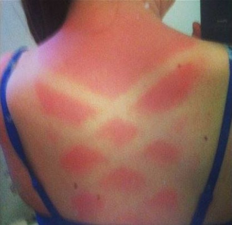 Illustration de l'article : 12 fails de bronzage magistraux