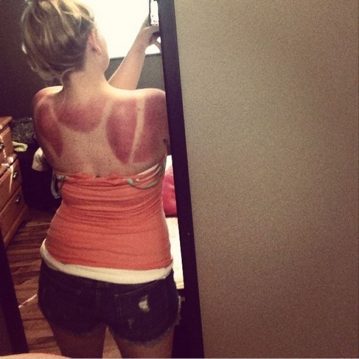 Illustration de l'article : 12 fails de bronzage magistraux