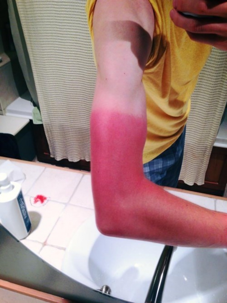 Illustration de l'article : 12 fails de bronzage magistraux