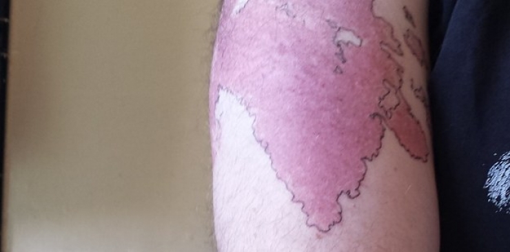 Illustration de l'article : Il dessine des îles et des côtes sur son bras pour une bonne raison