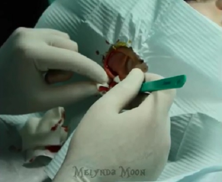 Illustration de l'article : Elle s'est faite opérer pour avoir quelque chose d'inimaginable...Drôle de passion...