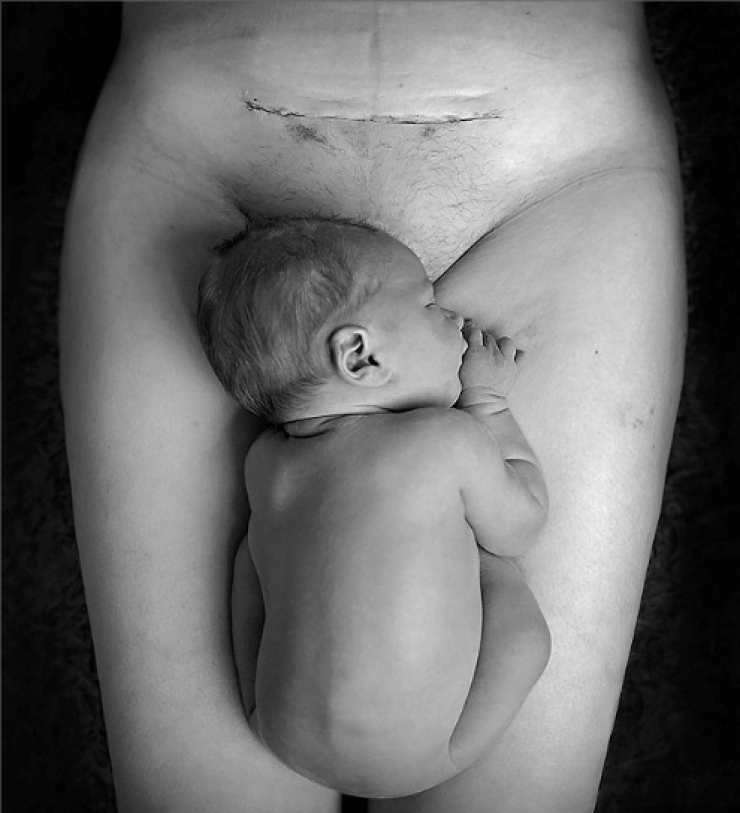 Illustration de l'article : Cette m&egrave;re a d&eacute;cid&eacute; de publier la photo de la cicatrice qui a sauv&eacute; la vie de son b&eacute;b&eacute;...