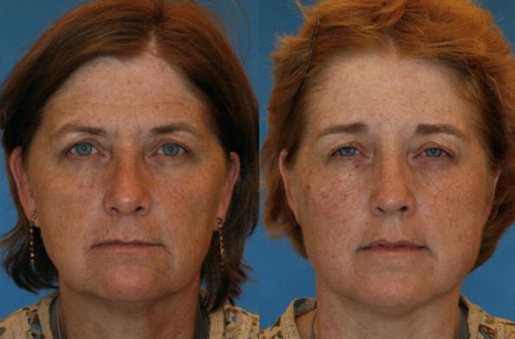 Illustration de l'article : Fumeurs Vs Non fumeurs... Ces 8 photos de jumeaux nous montrent que la diff&eacute;rence est flagrante !