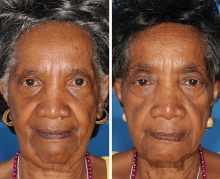 Illustration de l'article : Fumeurs Vs Non fumeurs... Ces 8 photos de jumeaux nous montrent que la diff&eacute;rence est flagrante !