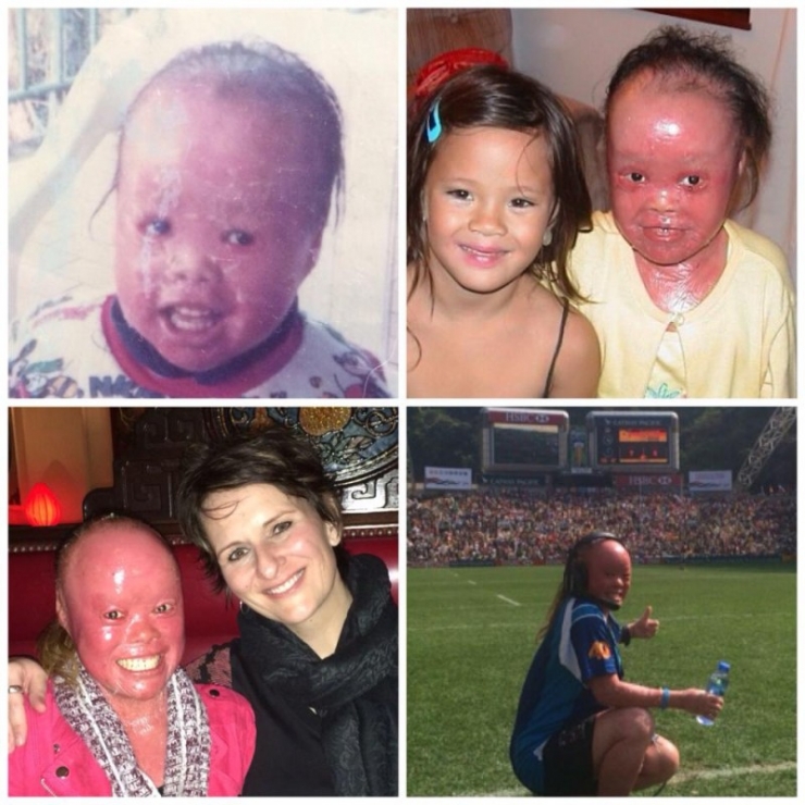 Illustration de l'article : On lui demandait de « cacher le visage hideux de ce bébé », mais admirez ce qu’elle est devenue !