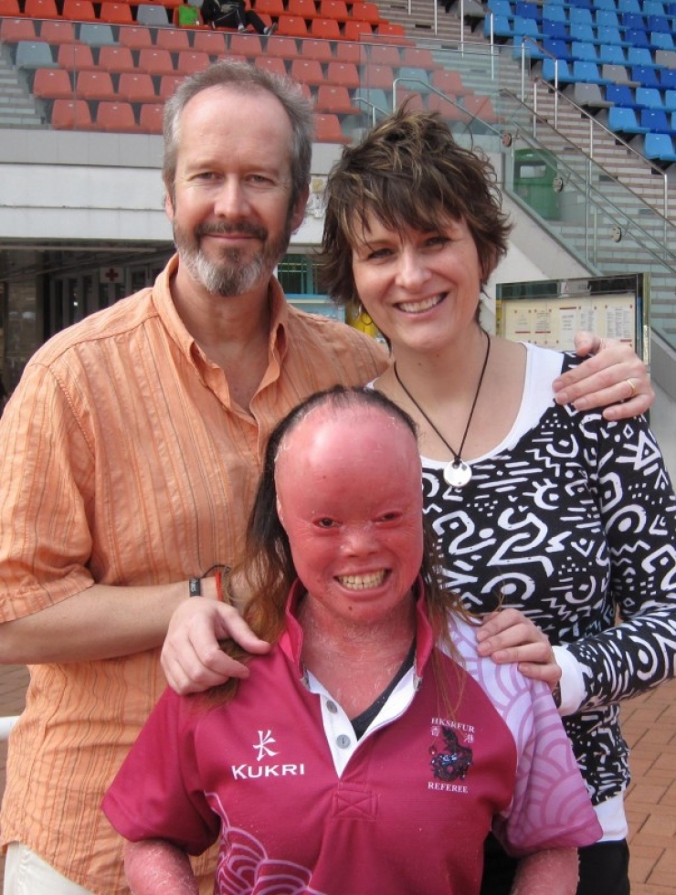 Illustration de l'article : On lui demandait de « cacher le visage hideux de ce bébé », mais admirez ce qu’elle est devenue !