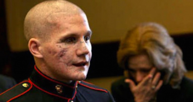 Illustration de l'article : D&eacute;figur&eacute; par une grenade, cet homme a pu b&eacute;n&eacute;ficier de la magie des chirurgiens. Quel changement...