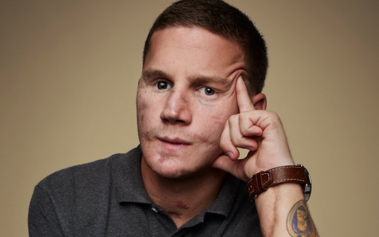 Illustration de l'article : D&eacute;figur&eacute; par une grenade, cet homme a pu b&eacute;n&eacute;ficier de la magie des chirurgiens. Quel changement...