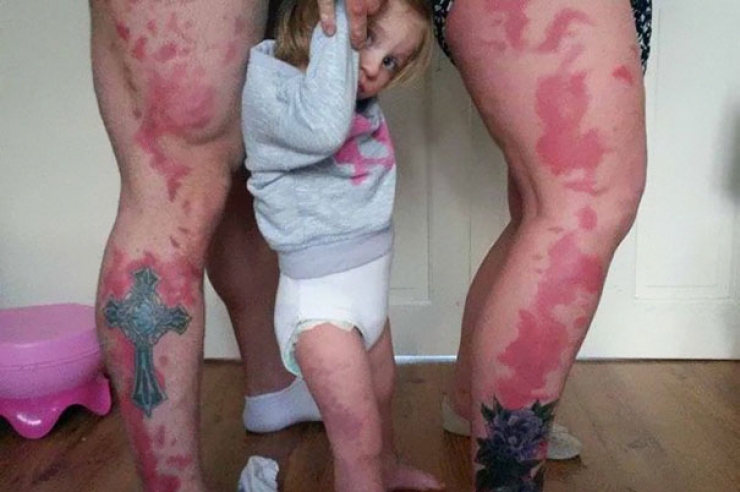 Illustration de l'article : Ces parents se font tatouer des taches de naissance pour aider leur fille à mieux vivre avec la sienne !