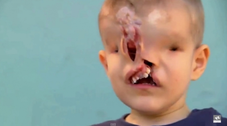 Illustration de l'article : Il &eacute;tait vou&eacute; &agrave; une vie mis&eacute;rable, sans nez et sans yeux mais la m&eacute;decine a fait un travail incroyable !