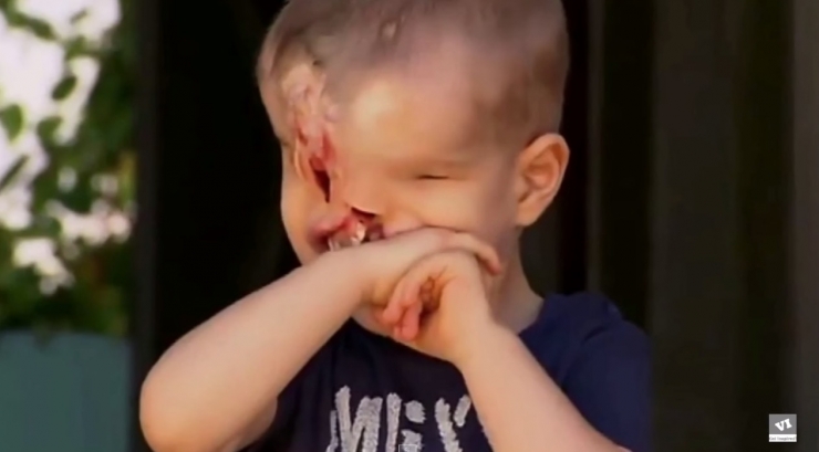 Illustration de l'article : Il &eacute;tait vou&eacute; &agrave; une vie mis&eacute;rable, sans nez et sans yeux mais la m&eacute;decine a fait un travail incroyable !