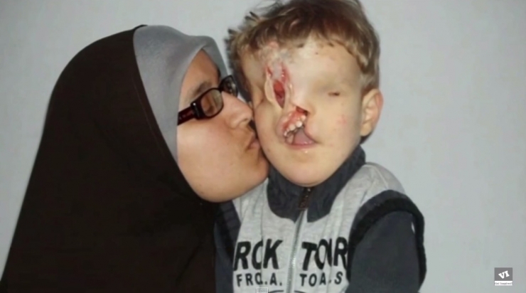 Illustration de l'article : Il &eacute;tait vou&eacute; &agrave; une vie mis&eacute;rable, sans nez et sans yeux mais la m&eacute;decine a fait un travail incroyable !