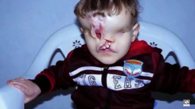 Illustration de l'article : Il &eacute;tait vou&eacute; &agrave; une vie mis&eacute;rable, sans nez et sans yeux mais la m&eacute;decine a fait un travail incroyable !