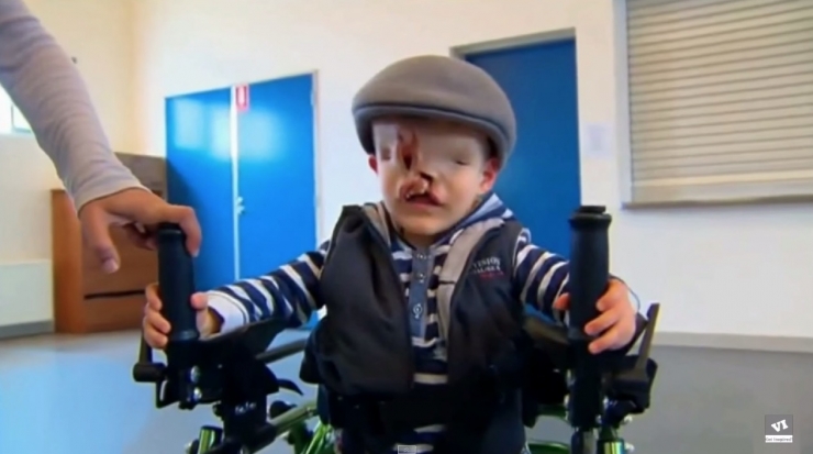 Illustration de l'article : Il &eacute;tait vou&eacute; &agrave; une vie mis&eacute;rable, sans nez et sans yeux mais la m&eacute;decine a fait un travail incroyable !