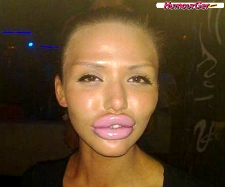 Illustration de l'article : Top 15 des chirurgies esth&eacute;tiques aux l&egrave;vres les plus pitoyables du moment. La 4 fait vraiment peur...