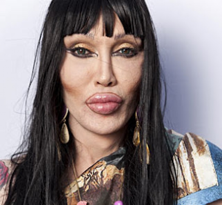 Illustration de l'article : Top 15 des chirurgies esth&eacute;tiques aux l&egrave;vres les plus pitoyables du moment. La 4 fait vraiment peur...