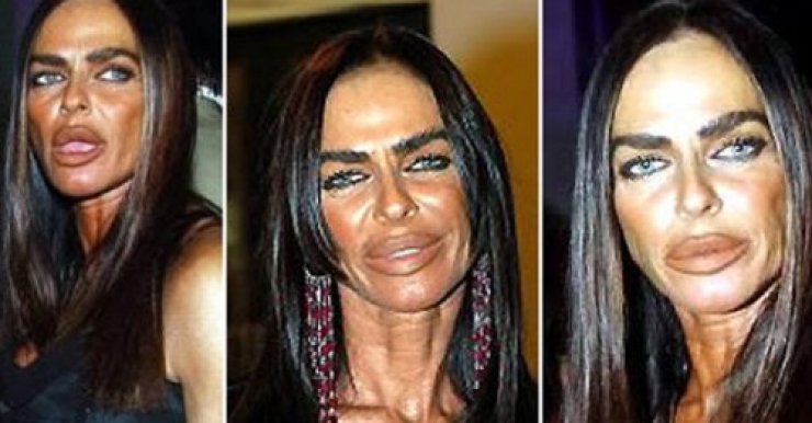 Illustration de l'article : Top 15 des chirurgies esth&eacute;tiques aux l&egrave;vres les plus pitoyables du moment. La 4 fait vraiment peur...