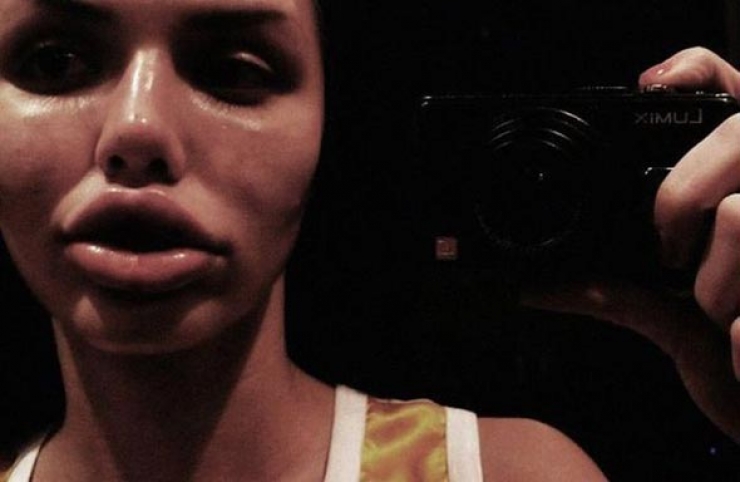 Illustration de l'article : Top 15 des chirurgies esth&eacute;tiques aux l&egrave;vres les plus pitoyables du moment. La 4 fait vraiment peur...