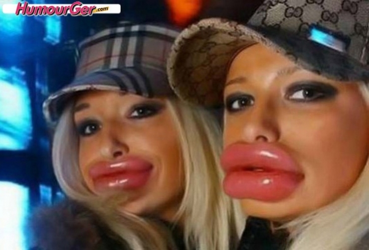 Illustration de l'article : Top 15 des chirurgies esth&eacute;tiques aux l&egrave;vres les plus pitoyables du moment. La 4 fait vraiment peur...