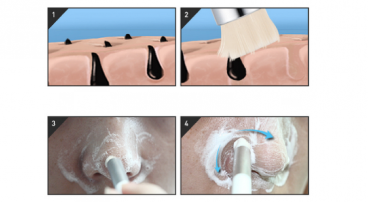 Illustration de l'article : Astuce de grand m&egrave;re pour vous &eacute;liminer vos points noirs et pour nettoyer vos pores...