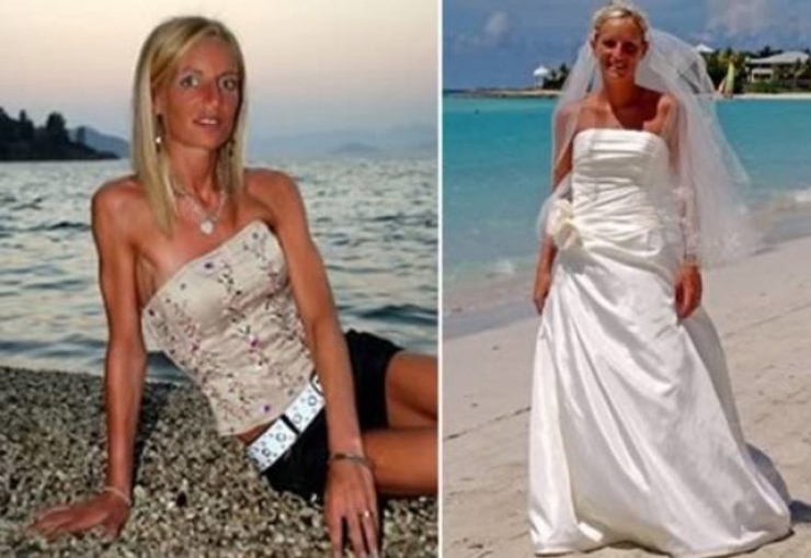 Illustration de l'article : 13 personnes souffrant d'anorexie s&eacute;v&egrave;re et qui ont r&eacute;ussi &agrave; s'en sortir ! Bravo...