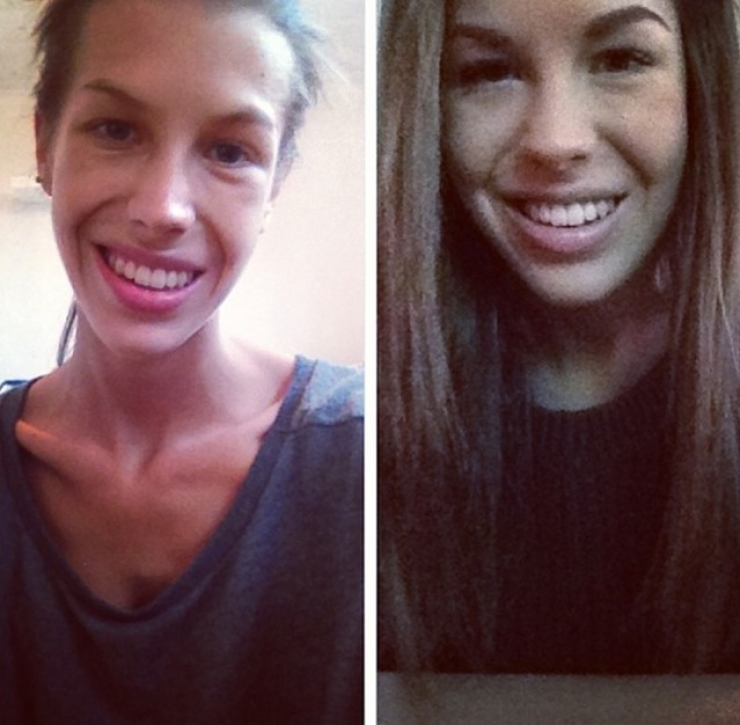 Illustration de l'article : 13 personnes souffrant d'anorexie s&eacute;v&egrave;re et qui ont r&eacute;ussi &agrave; s'en sortir ! Bravo...