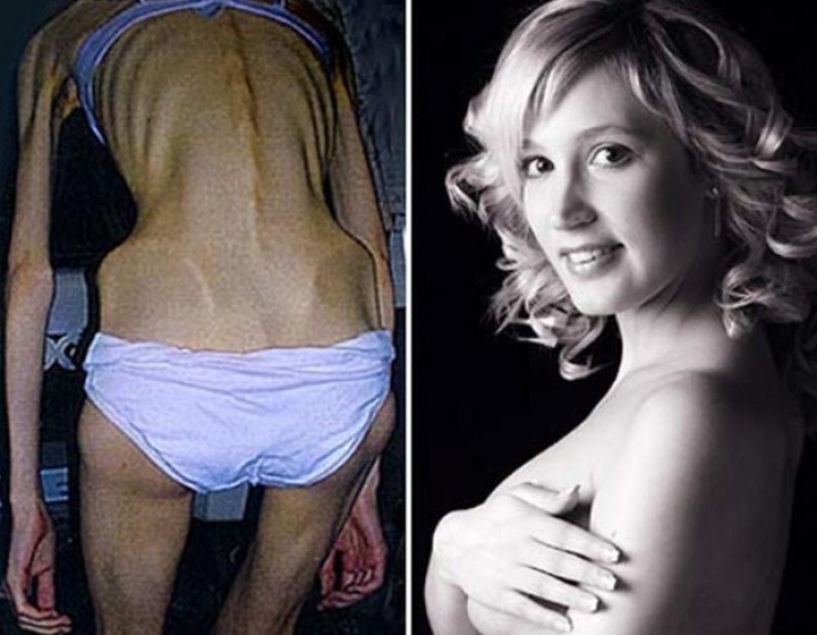 Illustration de l'article : 13 personnes souffrant d'anorexie s&eacute;v&egrave;re et qui ont r&eacute;ussi &agrave; s'en sortir ! Bravo...