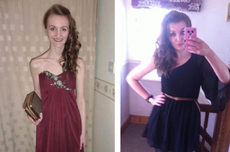 Illustration de l'article : 13 personnes souffrant d'anorexie s&eacute;v&egrave;re et qui ont r&eacute;ussi &agrave; s'en sortir ! Bravo...