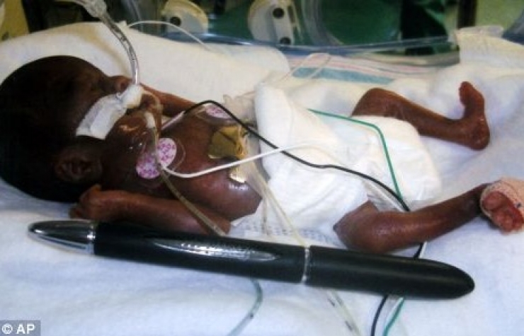 Illustration de l'article : Les docteurs ne donnaient aucune chance à ce foetus de 21 semaines...Et pourtant !