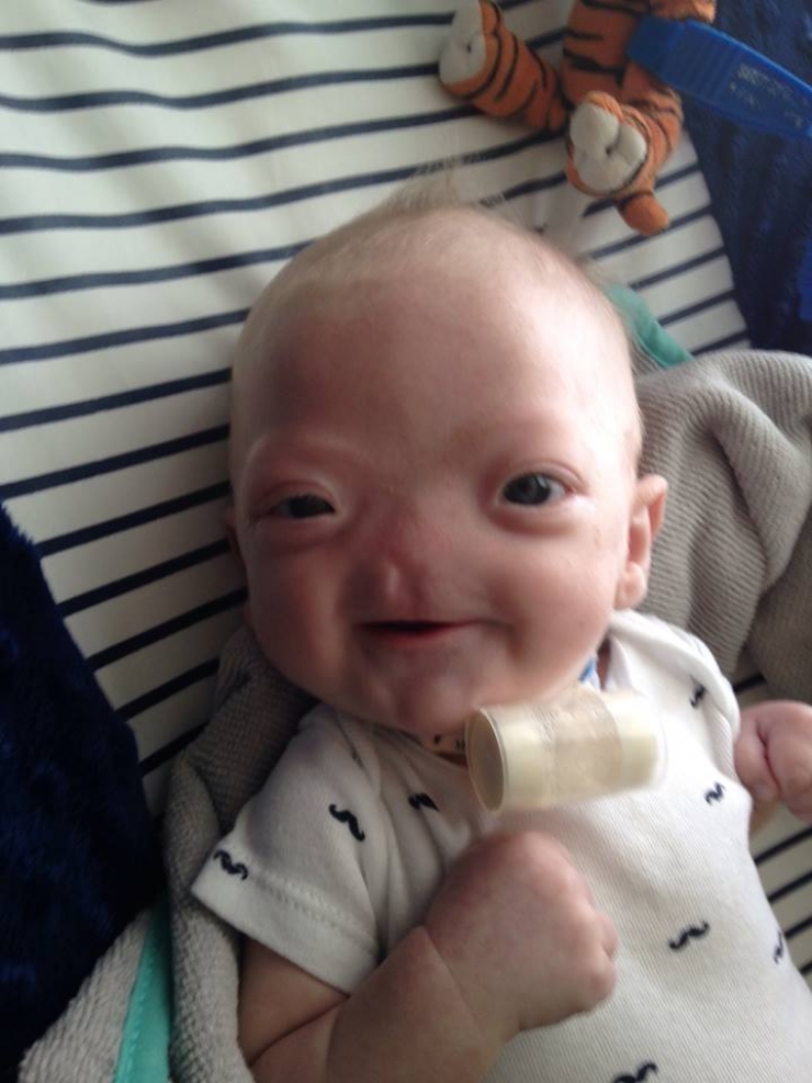 Illustration de l'article : N&eacute; sans nez, le petit Eli fait preuve d'un courage magnifique ! Ce qu'il est devenu fait plaisir &agrave; voir...