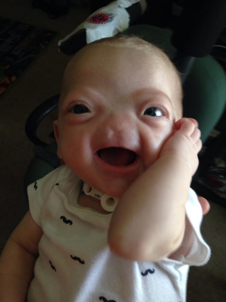 Illustration de l'article : N&eacute; sans nez, le petit Eli fait preuve d'un courage magnifique ! Ce qu'il est devenu fait plaisir &agrave; voir...