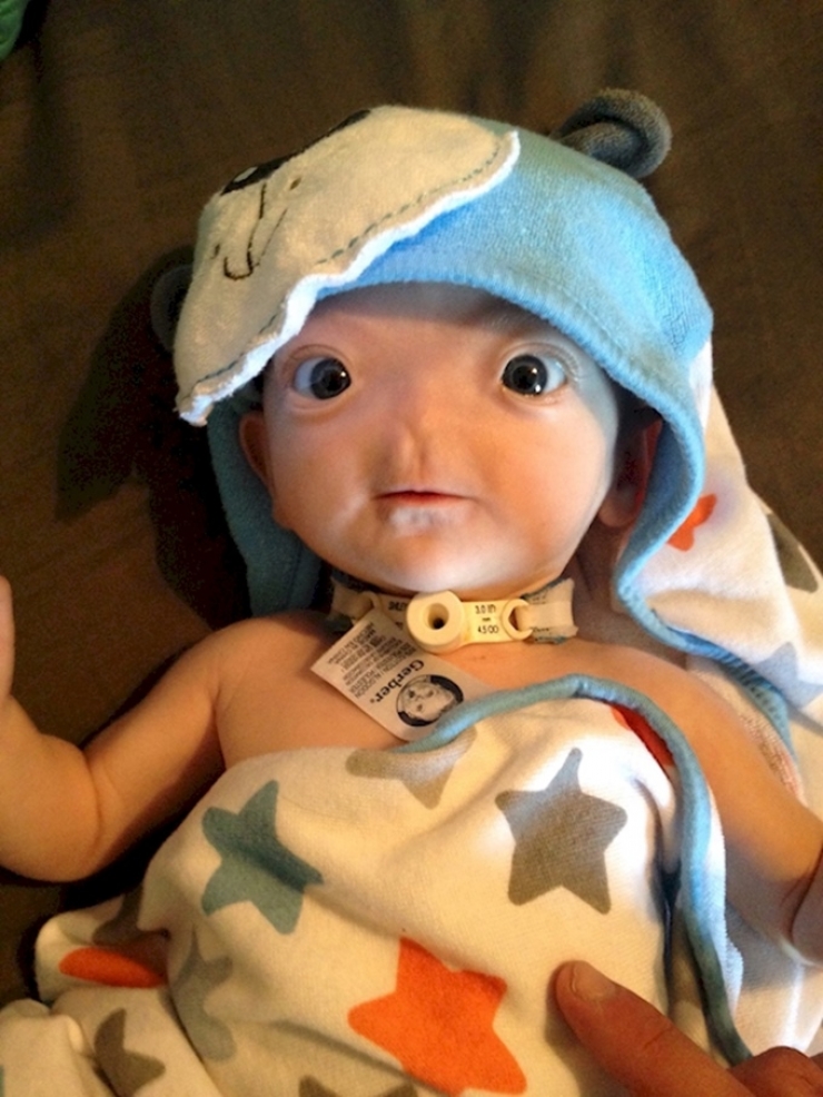 Illustration de l'article : N&eacute; sans nez, le petit Eli fait preuve d'un courage magnifique ! Ce qu'il est devenu fait plaisir &agrave; voir...