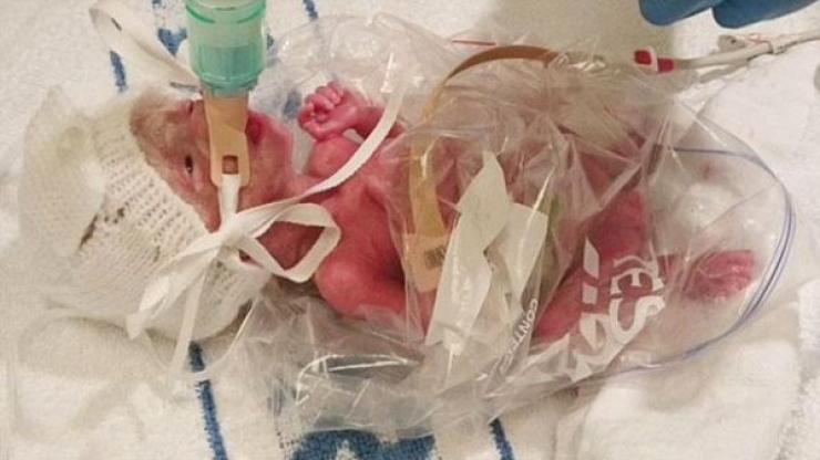 Illustration de l'article : Aussi incroyable que cela puisse paraitre, ce b&eacute;b&eacute; a &eacute;t&eacute; sauv&eacute; in extremis gr&acirc;ce &agrave; un sac en plastique...