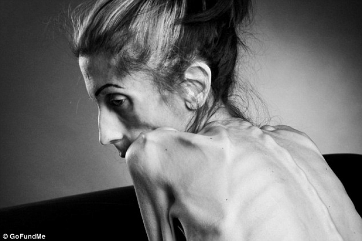 Illustration de l'article : En danger de mort avec un poids limite de 20kg, elle se prend en main et c&rsquo;est impressionnant de voir ce qu&rsquo;elle est devenue...