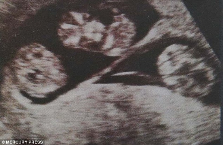 Illustration de l'article : Un médecin lui conseille d'avorter de ses foetus mais elle refuse ! Voilà ce qu'il s'est produit...
