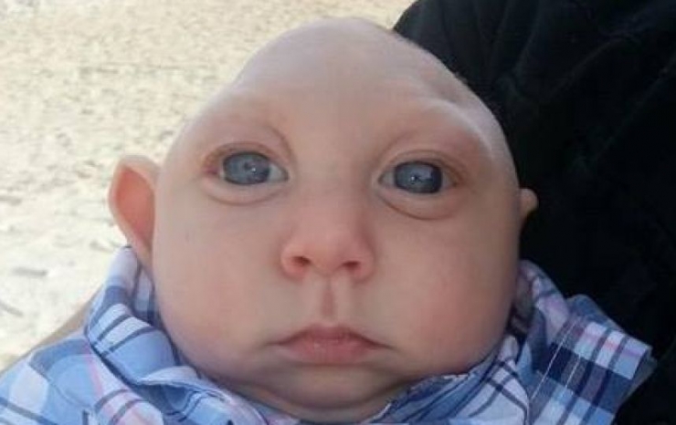 Illustration de l'article : Ce petit bout est un miracle, toujours en vie malgré l'avis des médecins et sa malformation au crâne...