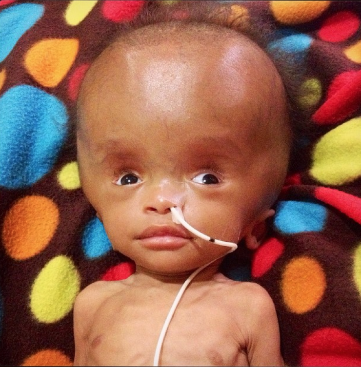 Illustration de l'article : Trouv&eacute; dans un tas d'ordures, regardez ce que ce b&eacute;b&eacute; est devenu 2 ans plus tard, gr&acirc;ce a beaucoup d'amour...