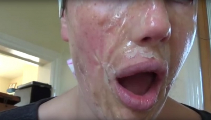 Illustration de l'article : Il vous suffit de ces deux ingr&eacute;dients pour vous d&eacute;barrasser de vos points noirs !