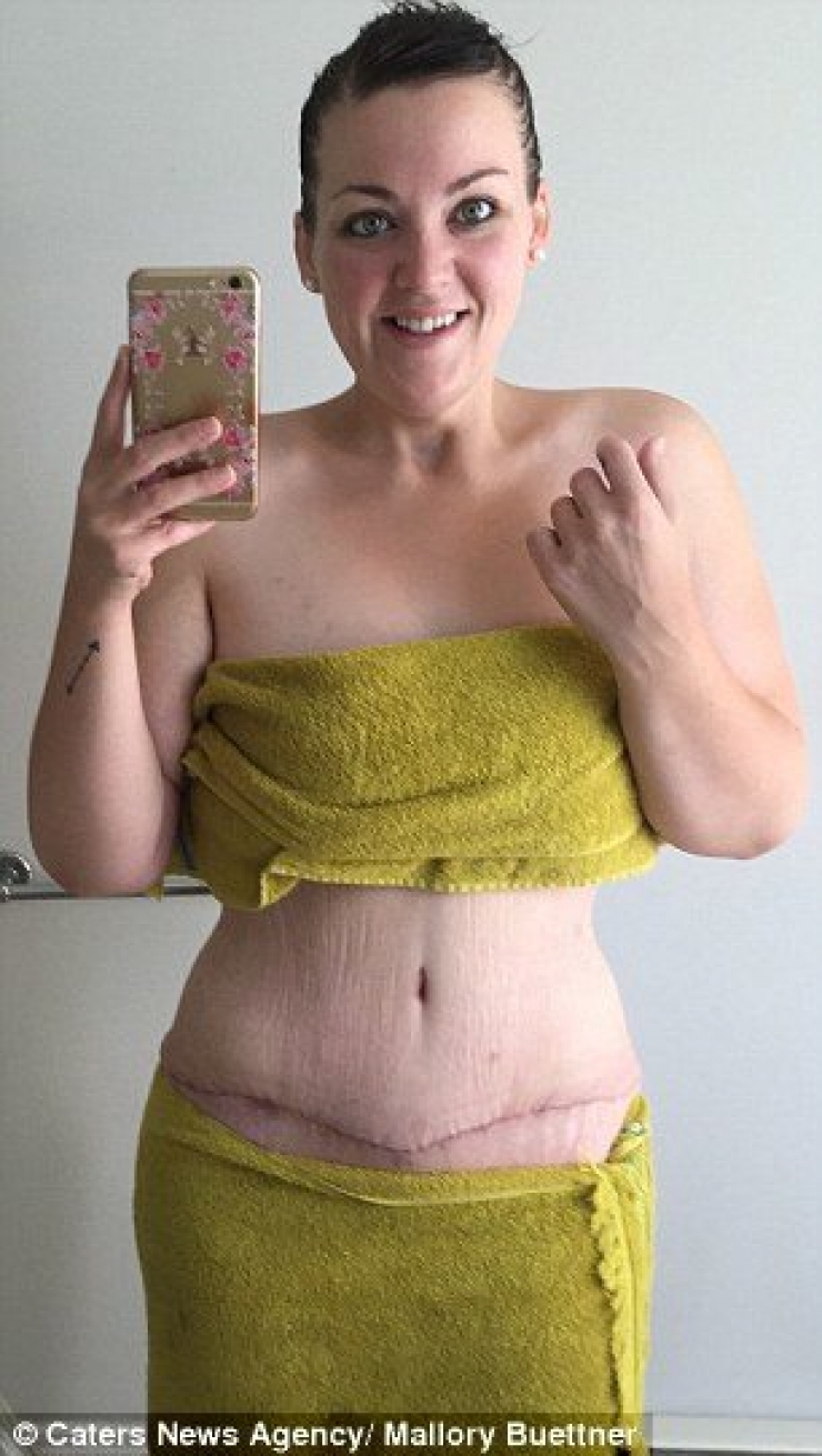 Illustration de l'article : Après un combat gagné contre son poids et une perte de 95 kilos, elle peut ENFIN porter un bikini.