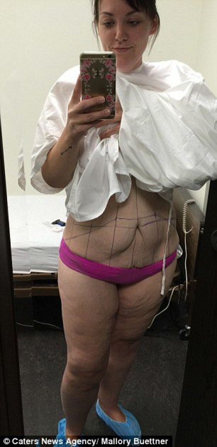Illustration de l'article : Après un combat gagné contre son poids et une perte de 95 kilos, elle peut ENFIN porter un bikini.