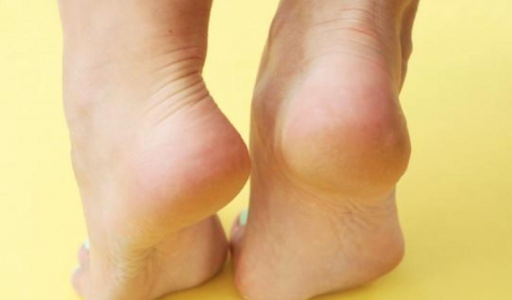 Illustration de l'article : Voici comment vous d&eacute;barrasser des talons craquel&eacute;s presque instantan&eacute;ment !