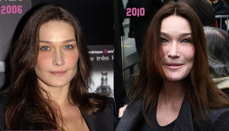 Illustration de l'article : 12 transformations &eacute;tonnantes de stars fran&ccedil;aises gr&acirc;ce &agrave; la chirurgie