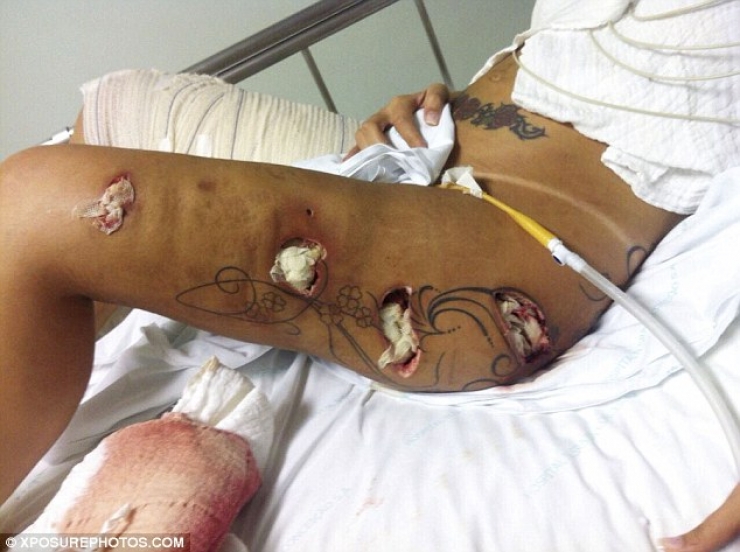 Illustration de l'article : Elle souffre de violentes douleurs aux fesses et le docteur lui fait une incision. Il avait rarement vu autant de pourriture!